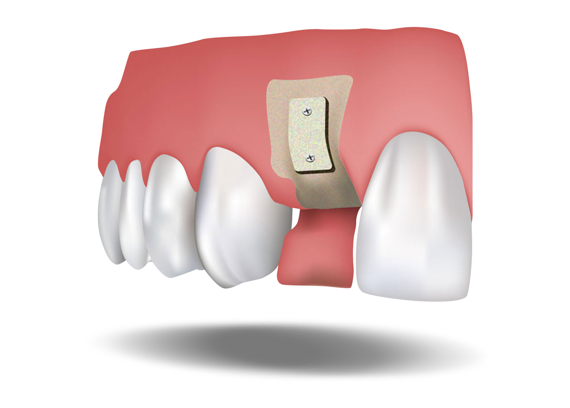 Bone graft illustration