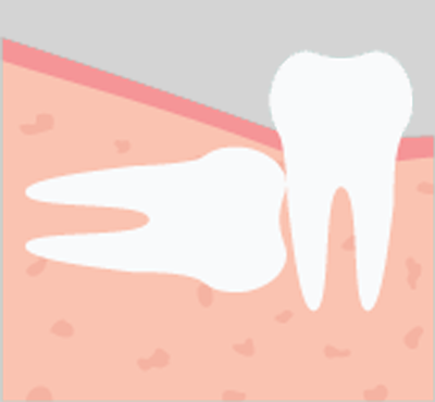 Horizontal Eruption - Baton Rouge Oral and Facial Surgery & Dental Implant Center - Baton Rouge, LA