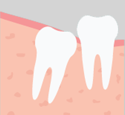 Partial Eruption - Baton Rouge Oral and Facial Surgery & Dental Implant Center - Baton Rouge, LA