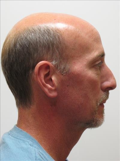 Chin Augmentation - after - Baton Rouge Oral and Facial Surgery & Dental Implant Center - Baton Rouge, LA