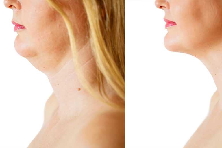 Facial Surgery Baton Rouge, LA Oral Surgeons