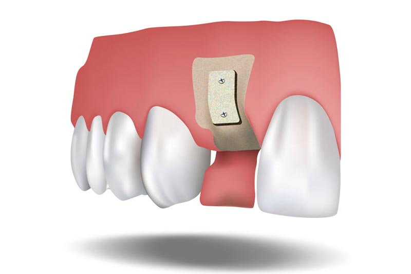 Wisdom Tooth Removal Impacted Wisdom Teeth Westminster, LA