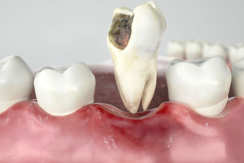 an image of a lower arch of teeth with a damaged tooth hovering above the surrounding teeth and gums.