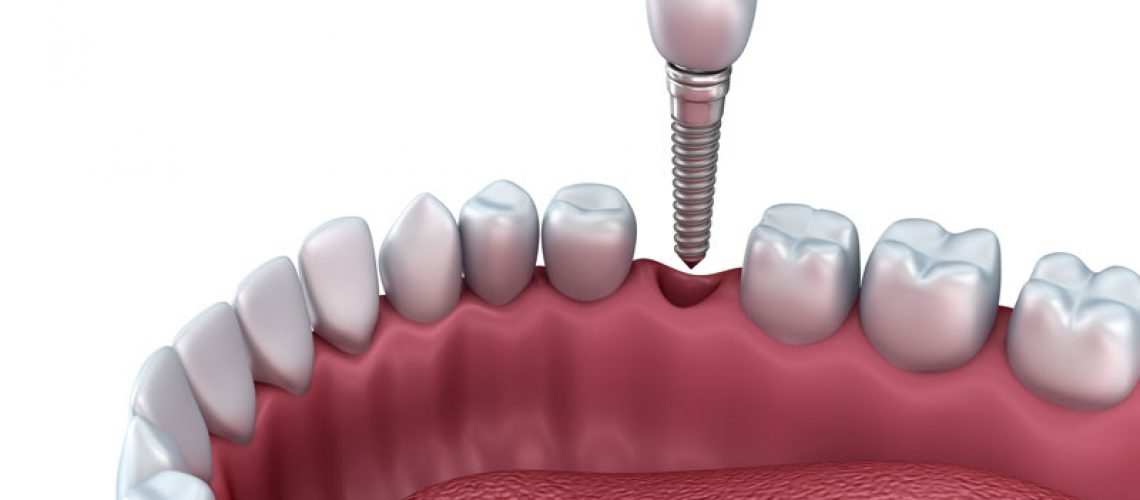 a single dental implant and post being placed into a lower jaw.