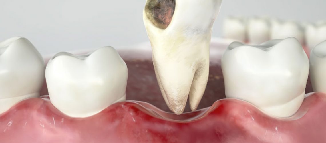 an image of a lower arch of teeth with a damaged tooth hovering above the surrounding teeth and gums.