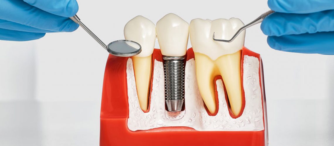 dental implant model bone cutaway showing a single post and dental implant
